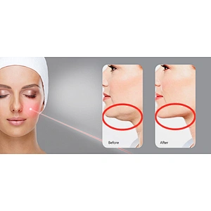 Laser Liposuction Machine Laser for Papada Lipo Laser Face Lifting Machine