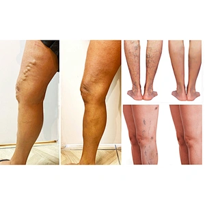 High quality radial fiber varicose veins 980nm diode laser 30w mini-invisive laser machine for evlt fibra radial