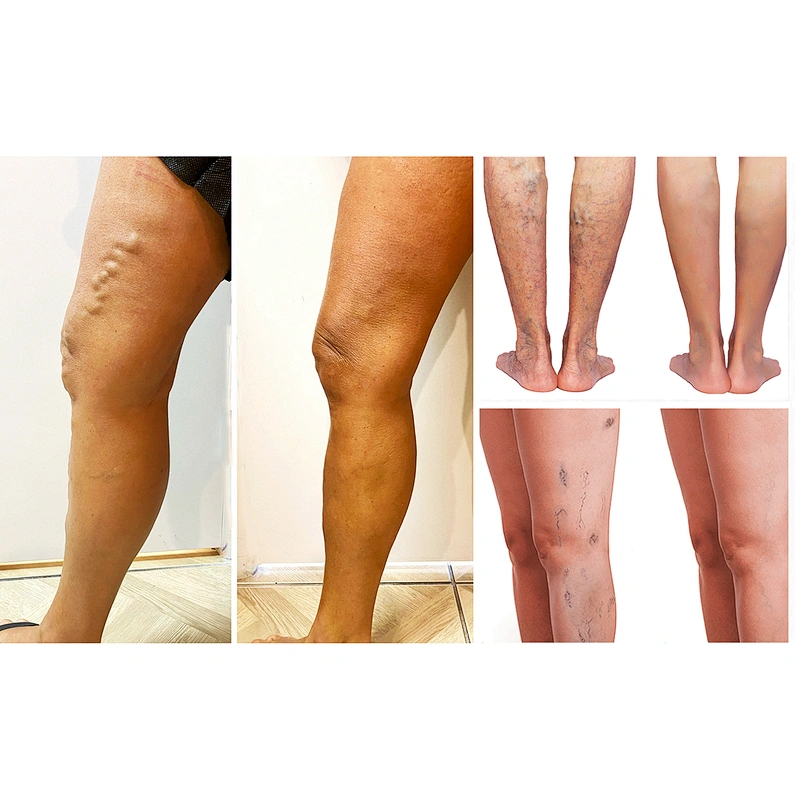 High quality radial fiber varicose veins 980nm diode laser 30w mini-invisive laser machine for evlt fibra radial
