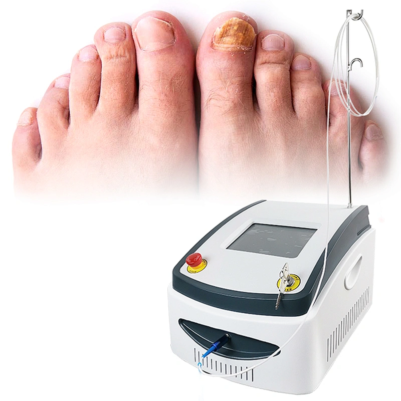 Laser Podiatry Onychomycosis Nail Fungus Treatment Diode Laser 1064 980 nm Fungal Nail Laser Machine
