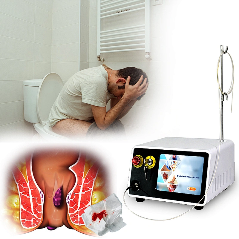 Hemorrhoids Treatment Surgery Diode Laser 1470nm With CE Hemorrhoids Laser Anal Fistula Hemorrhoids 980nm Laser