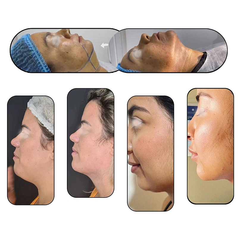 Triangel Laser Lipolysis 980nm Medical Liposuction Machine Endo Laser Fat Melting Lift Facial Equipment