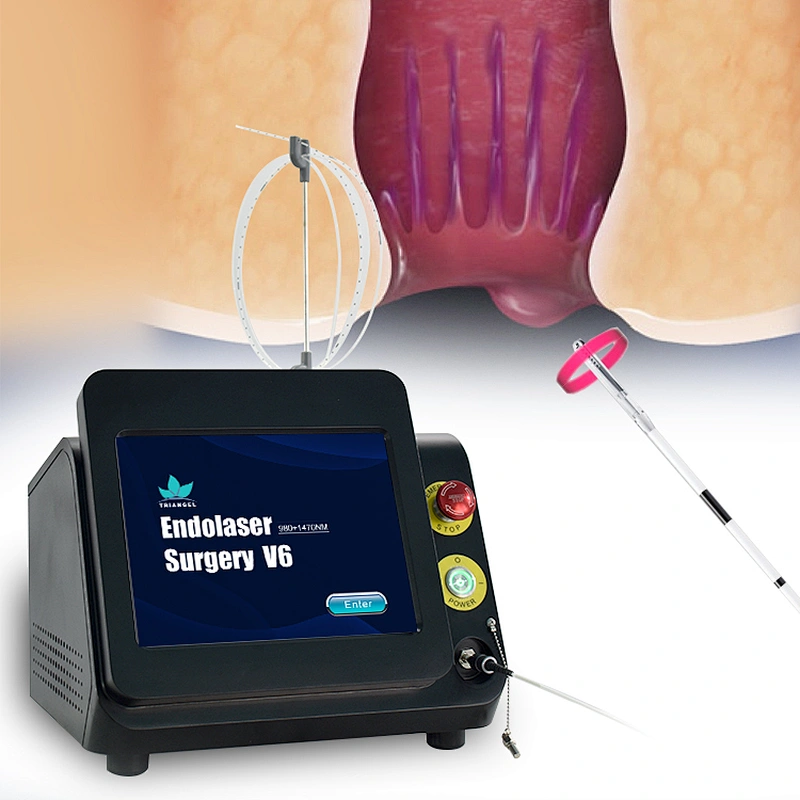 Laser  980nm 1470nm V6 Proctology Fistula Hemorrhoids Pilonidal Sinus