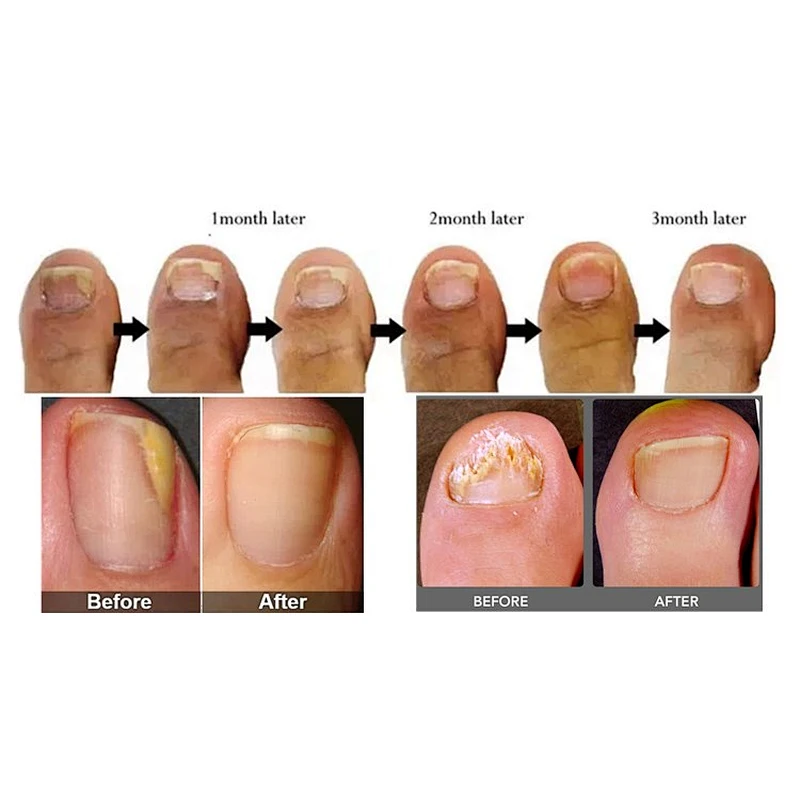 Hot Sale Class IV Diode Lase Treatment Nail Fungus Treatment Onychomycosi Toe Device