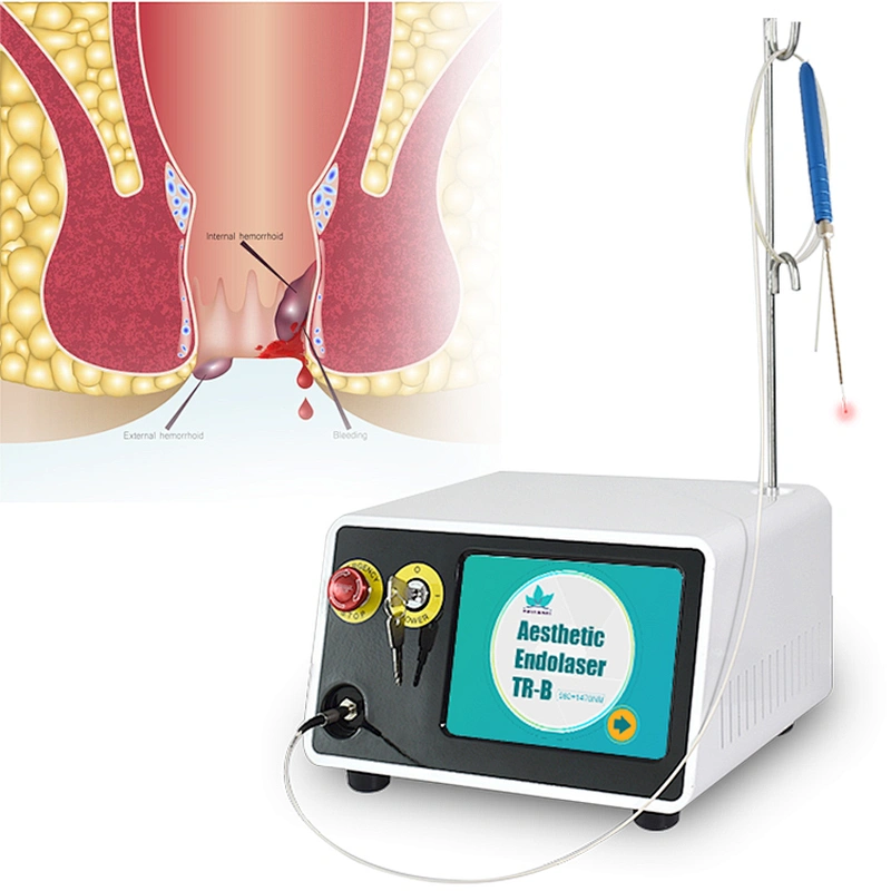 Hot Sale Portable 980nm 1470nm Hemorrhoid Diode Laser Excision Device for Proctology Hemorrhoid Piles Treatment