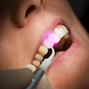 Hot Sale Diode Laser 1470nm 980nm Teeth Whitening Laser Medical Equipment Cutting Soft Tissue Dental Laser Machine