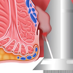 High Quality Chinese Manufacturer Anorectal Laser 980nm 1470nm Hemorrhoid Intestinal Hair Sinusiostomy Machine