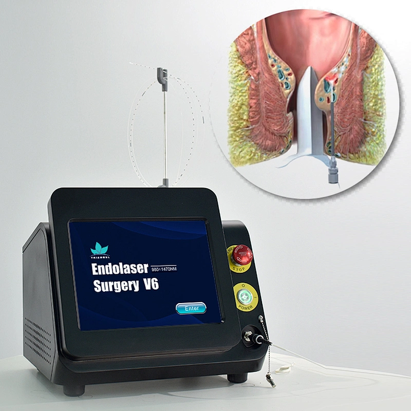 980nm 1470nm Diode Laser for Hemorrhoids Removal Surgery Proctology Haemorrhoids Cutting