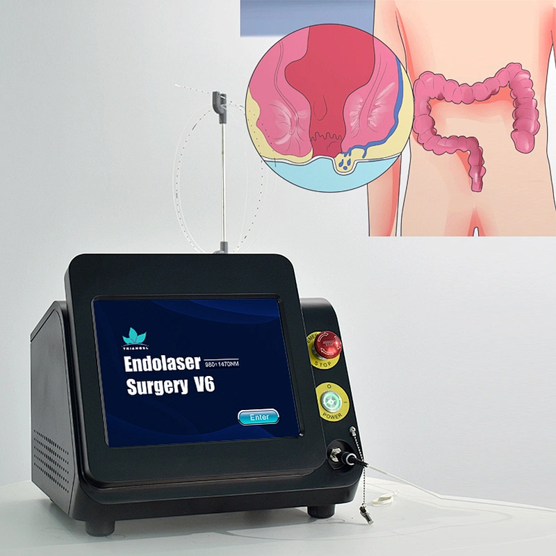 Anal Fistula and Hemorrhoids Fiber Laser Equipment Anal Piles Fistula Fissure and Pilonidal Sinus Diode 980nm 1470nm