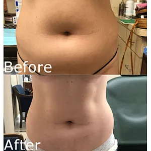 Fiberlift Lipolysis 980nm+1470nm Diode Laser Liposuction Machine Removal Eye Wrinkles Endolaser Lifting