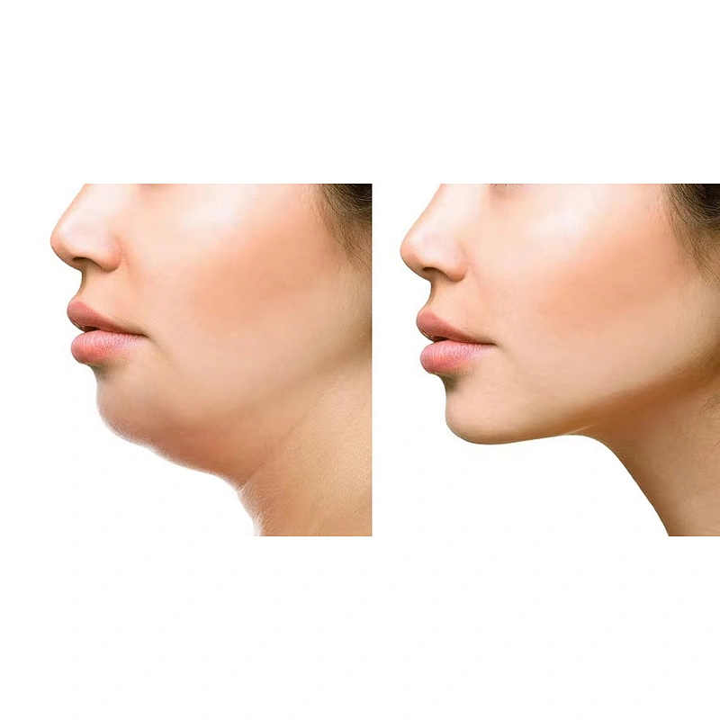 Skin Lifting Liposuction Laser 980nm 30w Lipolysis Beauty Machine Skin Tightening Face Lifting