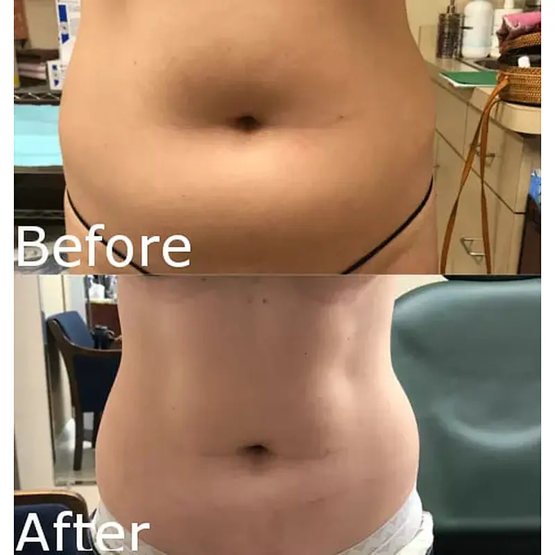 Factory Supply Best Quality Liposuction Lipolysis Endolaser Fat Reduction Skin Rejuvenation Face Lifting Laser 1470nm