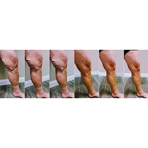 980nm EVLT Varicose Vein Laser Treatment 1470nm Diode Fiber Laser Mini-invasive EVLT Surgery
