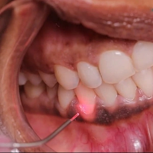 2025 High Quality Portable 980nm Laser 60W Non-invasive Dental Medical Fiber for Dental Soft Tissue Treatment