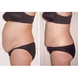 Multifunction Surgical Lipolysis 980nm 1470nm  Laser Liposuction