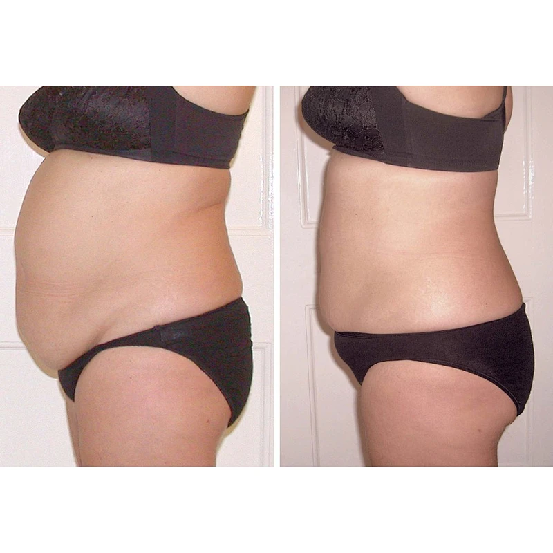 Multifunction Surgical Lipolysis 980nm 1470nm  Laser Liposuction