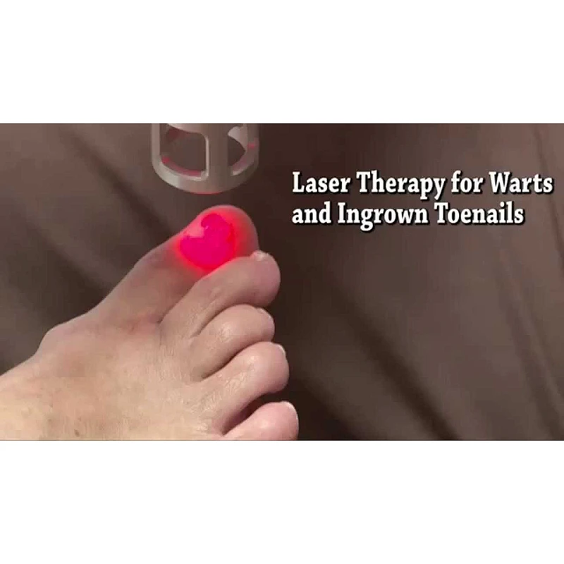 2023 Triangel Laseev Podiatry Laser Therapy  980nm Onychomycosis Nail Fungus Removal Podiatry Laser
