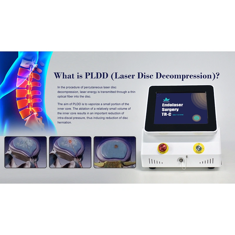2024 the Hottest Machine PLDD Laser Treatment Diode Laser 980nm 1470nm for PLDD