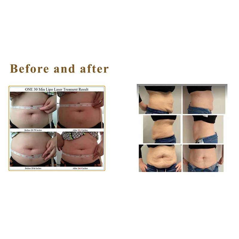 2023 New Technology Surgical Laser Liposuction Machine Cannula Endolaser