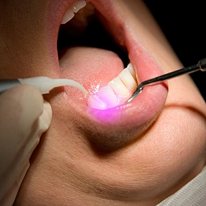 Dental Soft Tissue Laser Machine 980nm 1470nm Diode Dental Laser Treatment Teeth Whitening Instrument