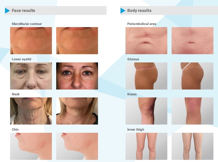 Endolift Laser