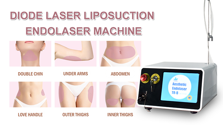 lipolysis laser