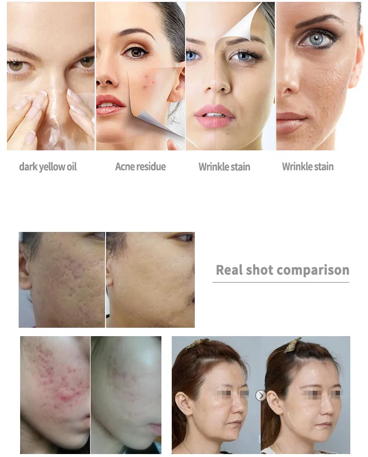 6 in 1 hydra facial machine