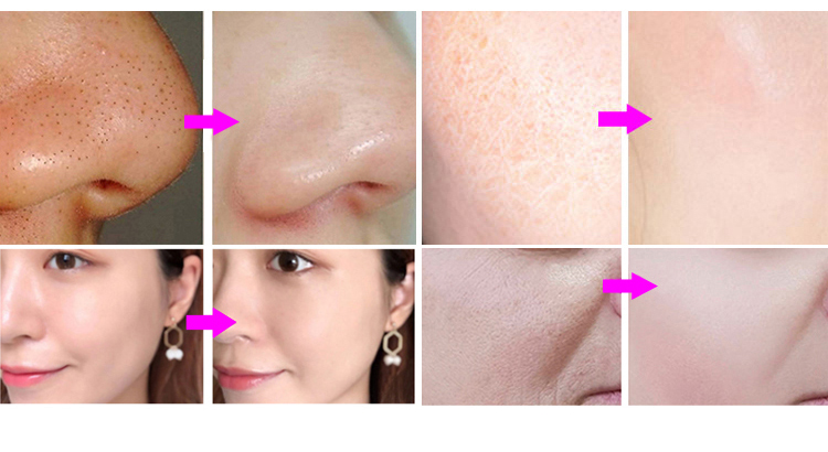 7 in 1 oxygen facial sprayer skin scrubber hydra facial