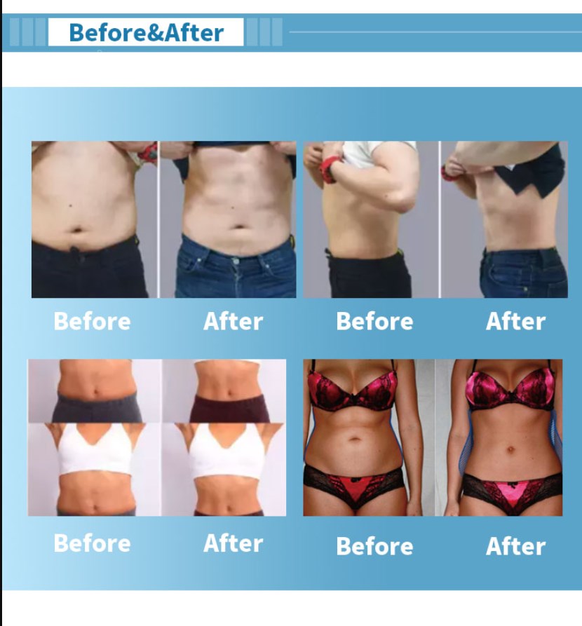 BTL EMSculpt body slimming machine