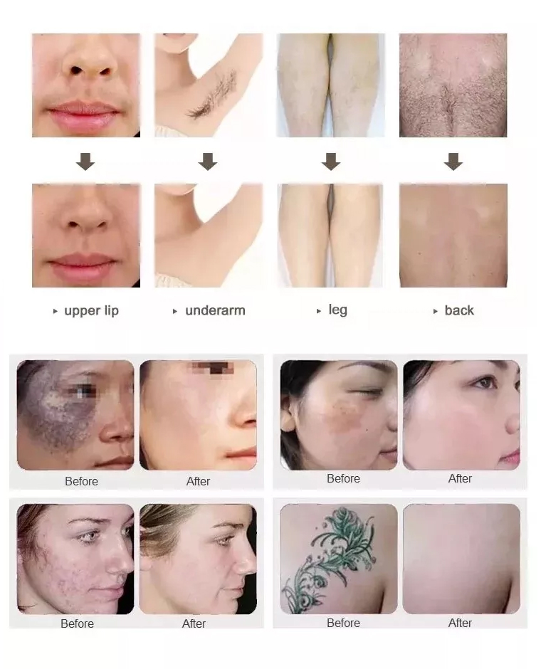 Painless Ipl skin rejuvenation laser hair removal