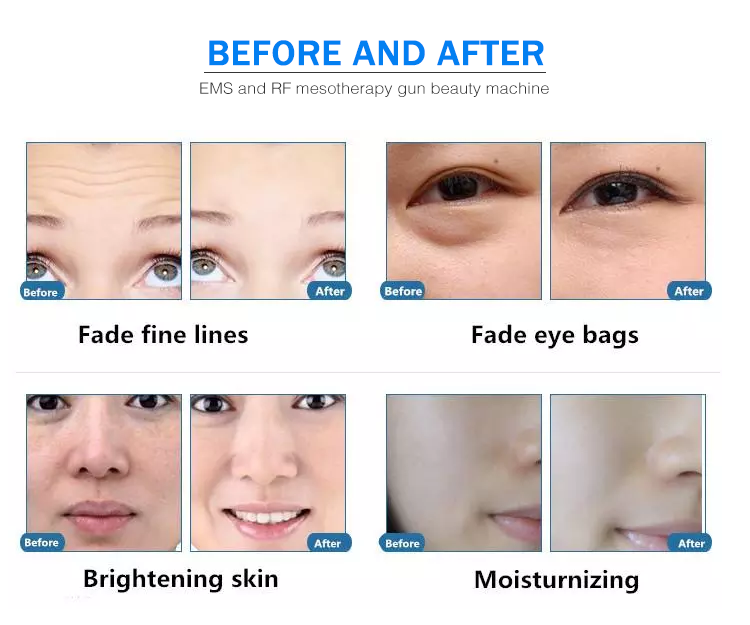 EMS RFnano Needle Gun Injector rejuvenation whitening