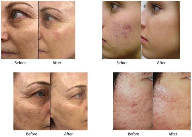 RF microneedling machine