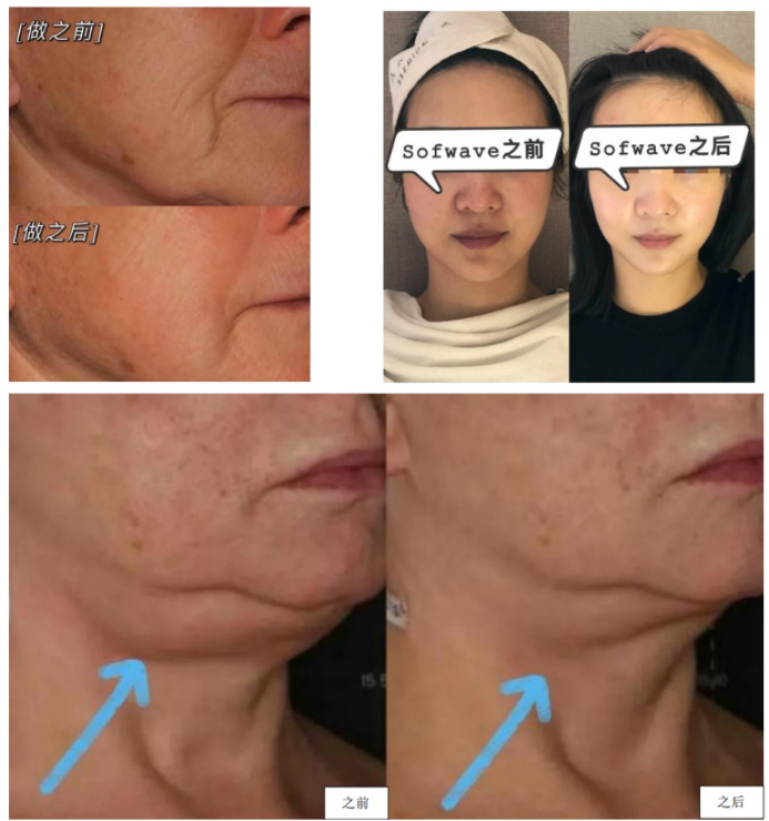 Tighten Wrinkle Removal And Skin Rejuvenation Lift Firming