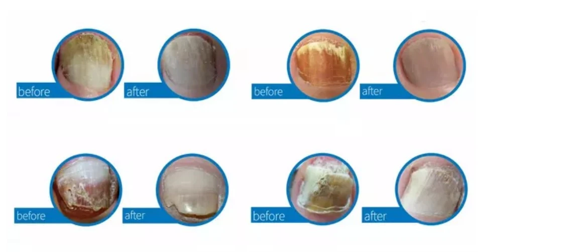 Toenail Fungus nail laser treatment device
