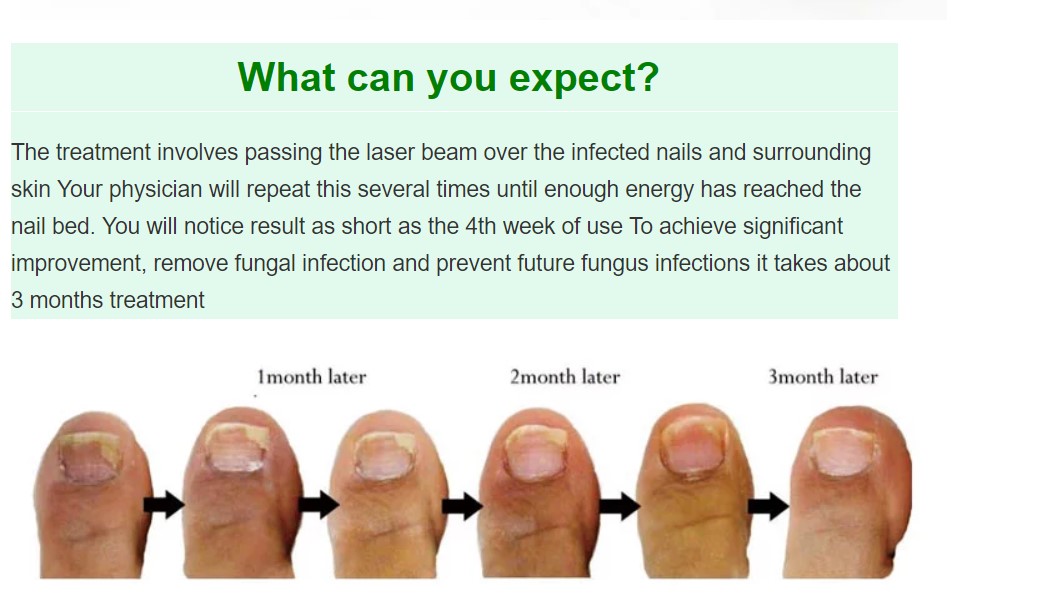 Toenail Fungus nail laser treatment device