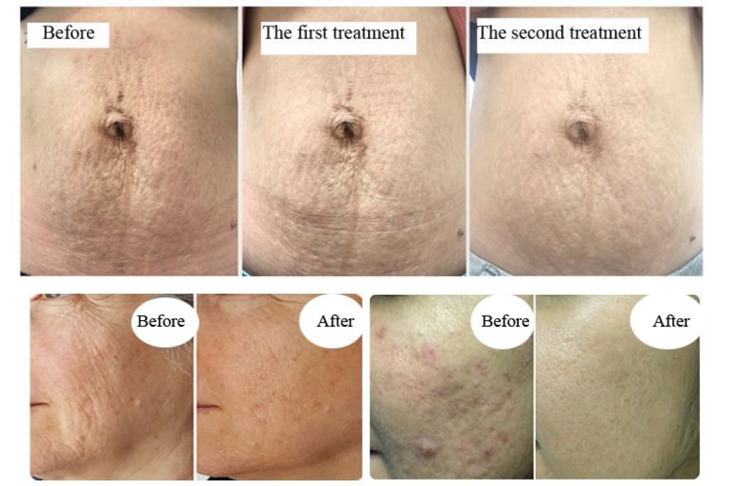 RF Frequency Fraxel Tixell 2 Novoxel Fractional Remaval Scars Machine with handles micro-needle