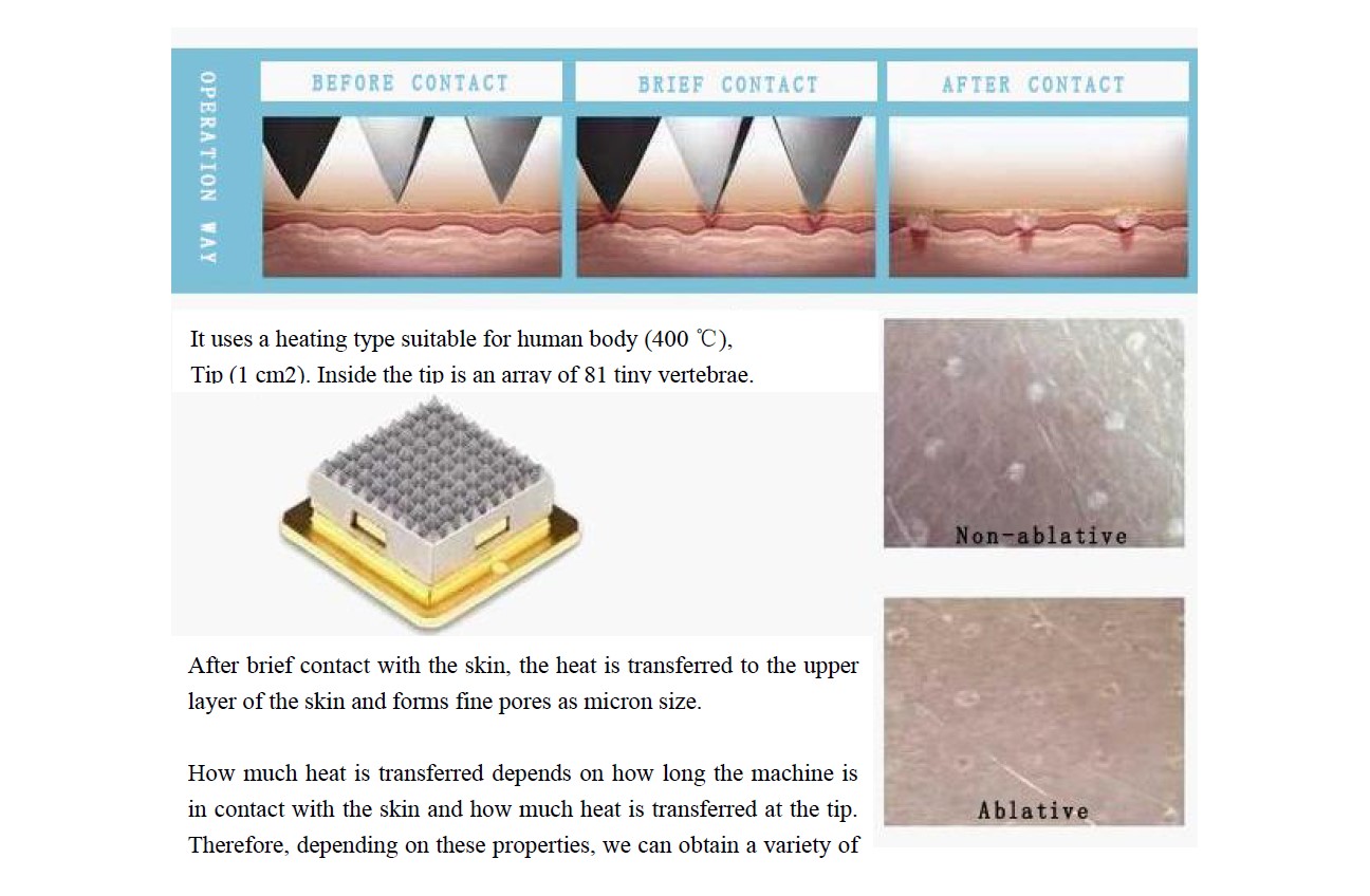 RF Frequency Fraxel Tixell 2 Novoxel Fractional Remaval Scars Machine with handles micro-needle