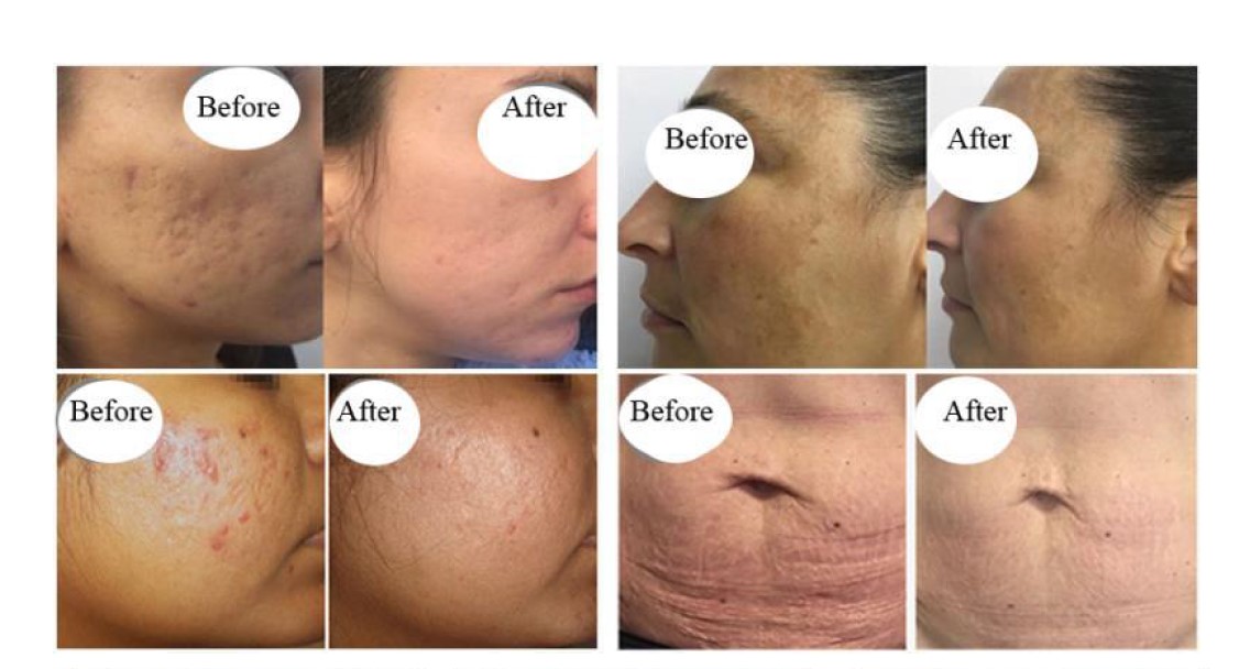RF Frequency Fraxel Tixell 2 Novoxel Fractional Remaval Scars Machine with handles micro-needle