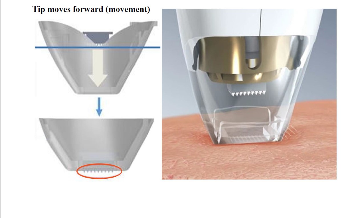 RF Frequency Fraxel Tixell 2 Novoxel Fractional Remaval Scars Machine with handles micro-needle