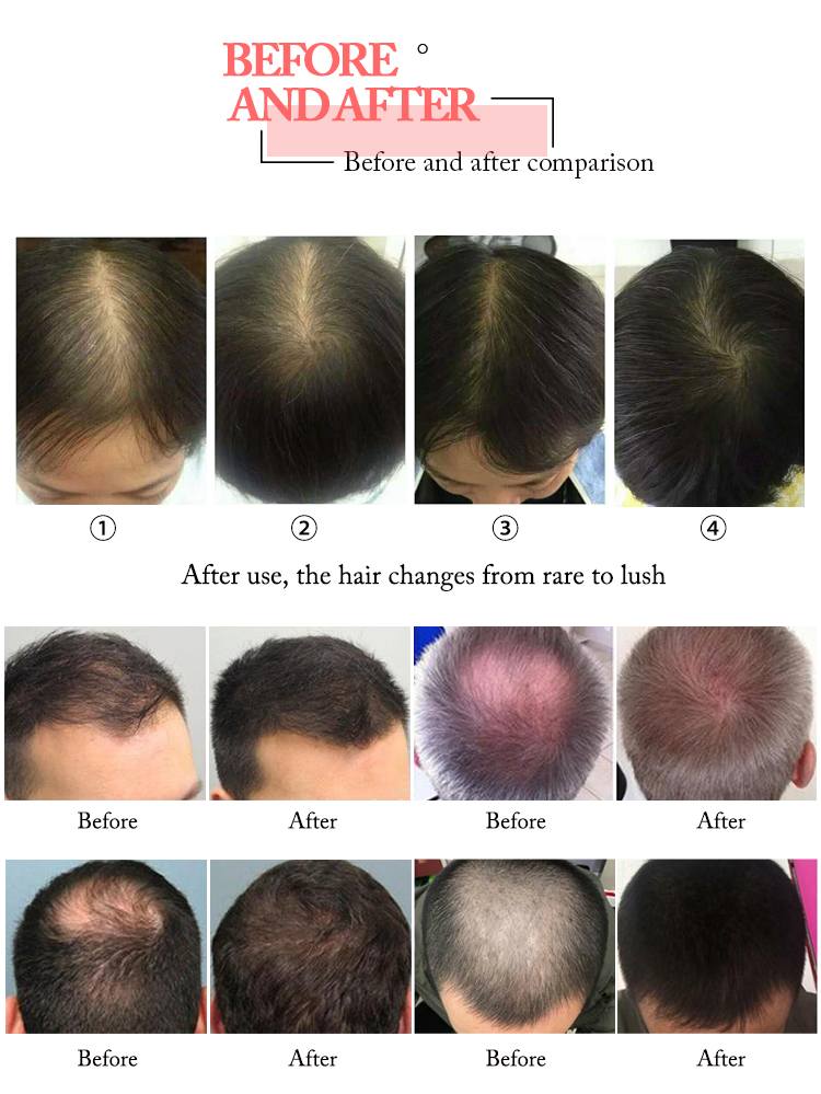 Hair loss treatment 660nm laser hair regrowth equipment HR68