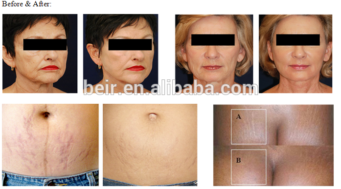 Aribaba hydra dermabrasion peeling microdermabrasion facial led lights oxygen jet hidra face hydra skin facial machine spa600