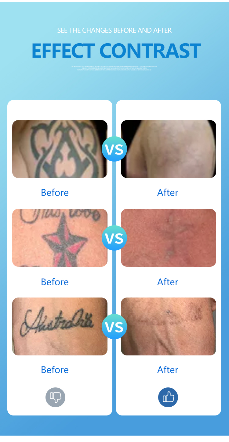 Q Switched Nd Yag Laser Tattoo Removal Machine