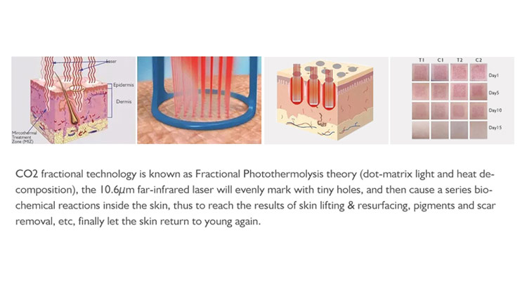 Fractional Co2 laser