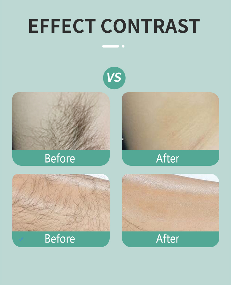 diode hair removal machine