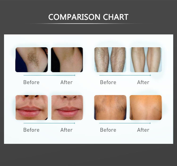 diode laser 808nm hair removal