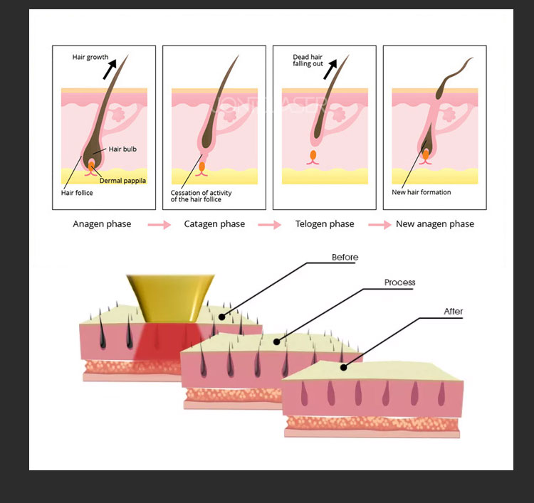 Best 3 wavelengths hair removal
