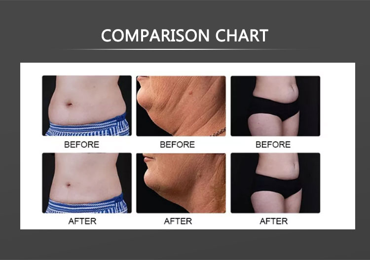 Cryotherapy slimming machine