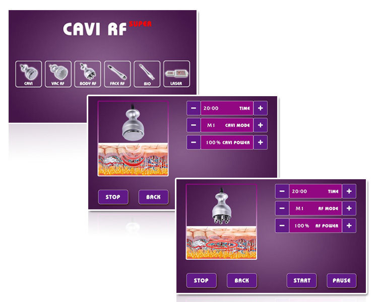 Vacuum liposuction Cavitation