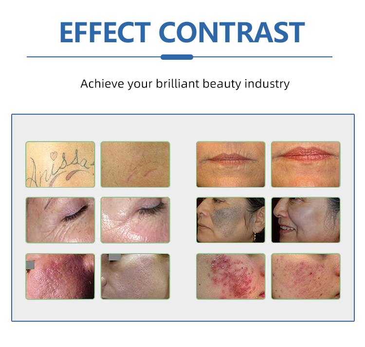 Picosecond Laser Tattoo Removal Machine