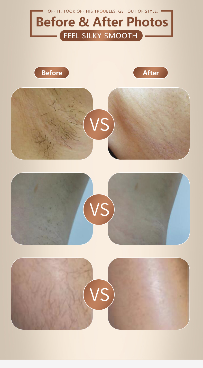 diode laser hair removal machine